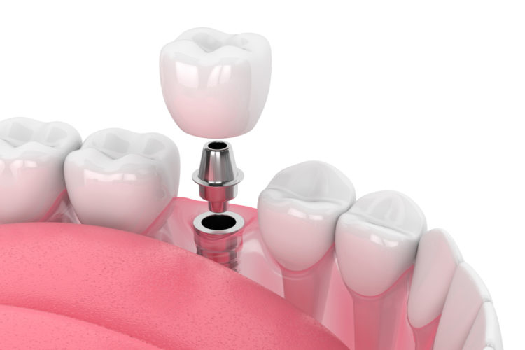 Consultation for Implant treatment