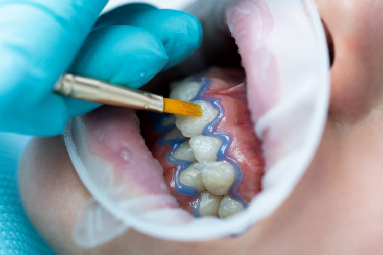 Teeth,Whitening,Procedure.,Tooth,Whitening,Gel.,Dentist,Does,The,Whitening