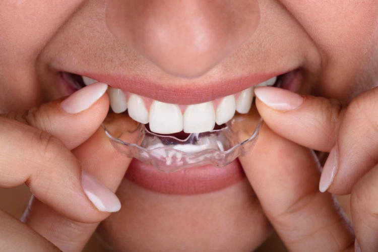 braces braces
