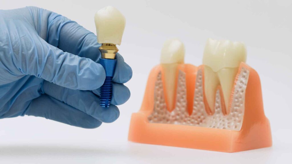 dental implants