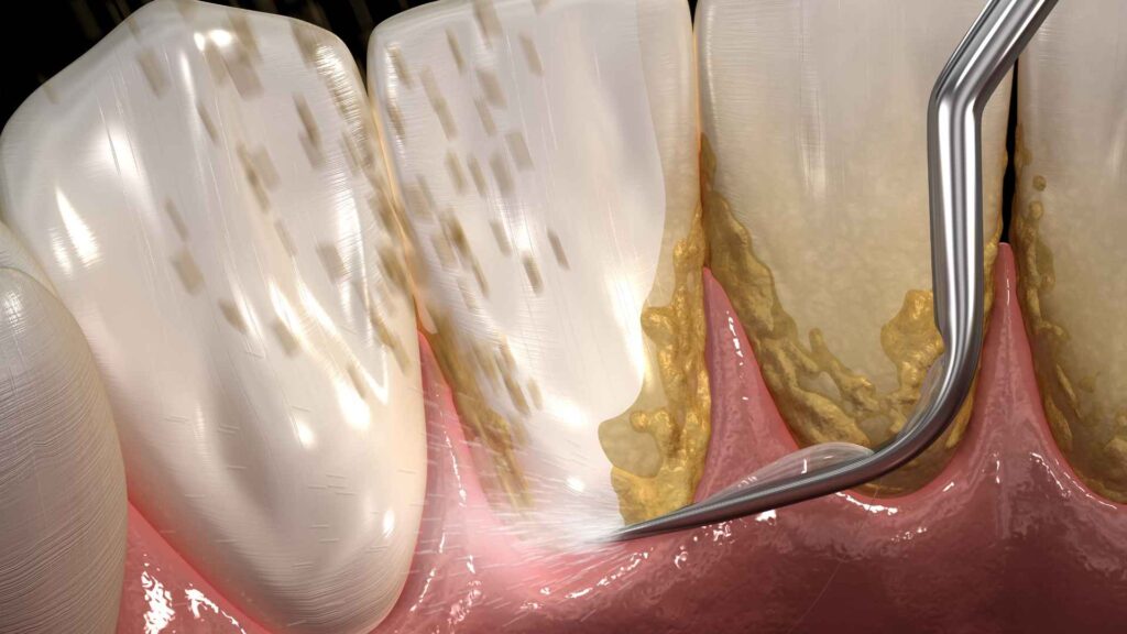 interdental brushes