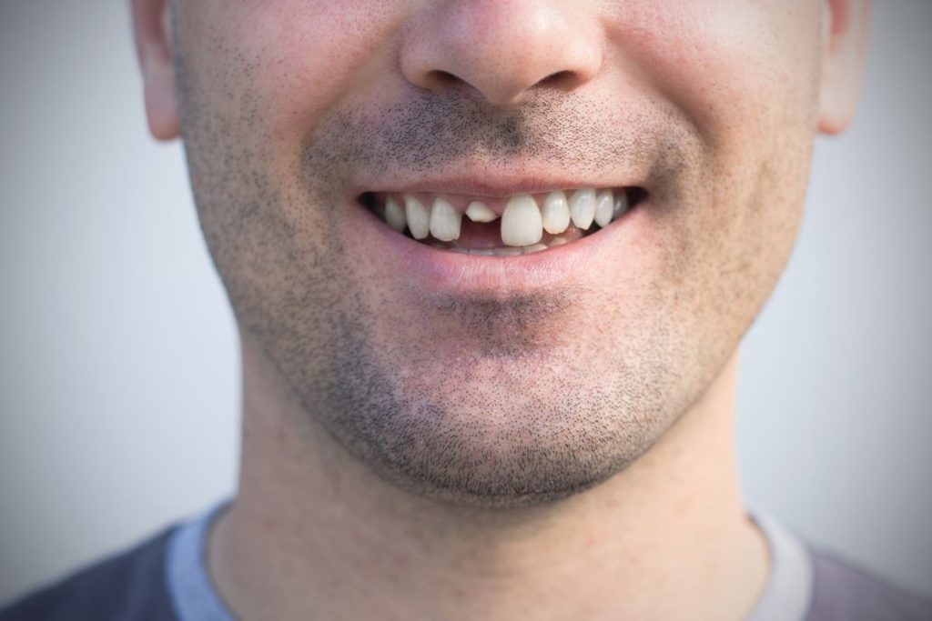 guy with a broken tooth