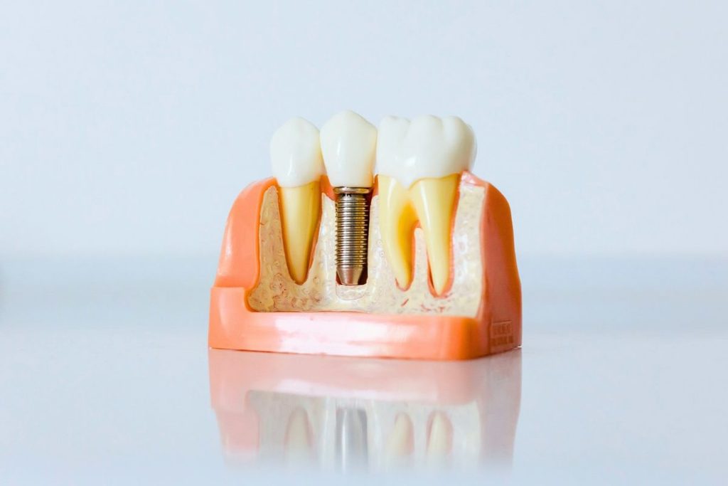 structure of a dental implant
